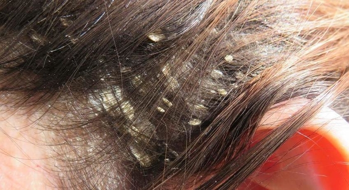 Hair diseases that cause hair